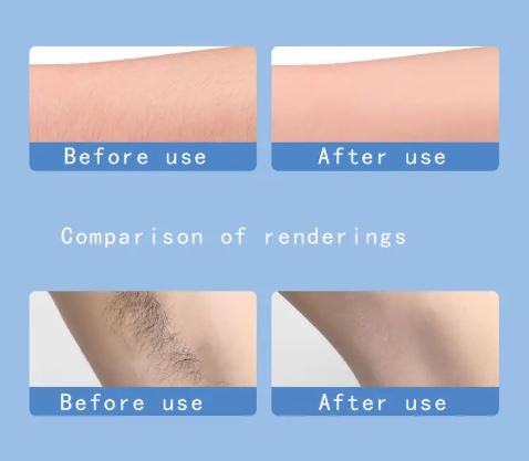 Painless hair remover